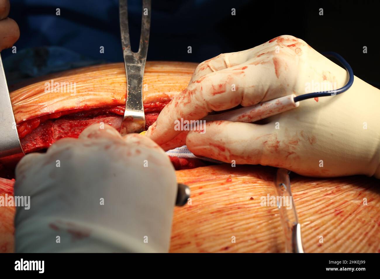 Nahaufnahme der Hände des Chirurgen mit Operationswerkzeugen auf dem Operationsfeld. Stockfoto