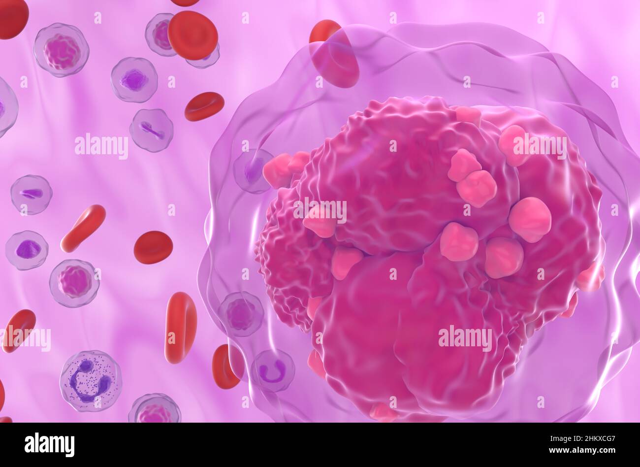 Akute lymphoblastische Leukämie (ALLE) Krebszelle im Blutfluss - super closeup Ansicht 3D Abbildung Stockfoto