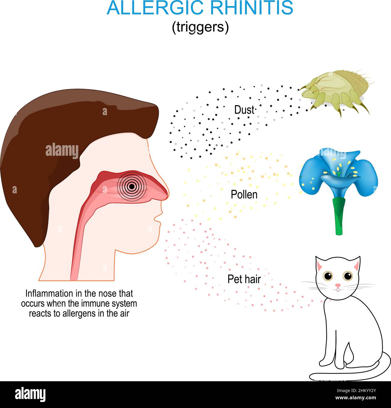 Allergische Rhinitis. Entzündung in der Nase, die auftritt, wenn das Immunsystem auf Allergene in der Luft reagiert. Auslöser: Staub, Pollen und Tierhaare Stock Vektor
