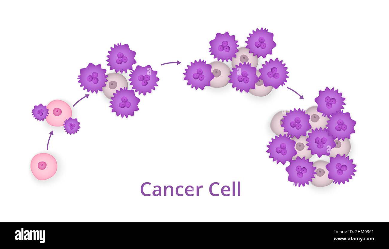 Prozess der Entwicklung von Krebszellen Stock Vektor