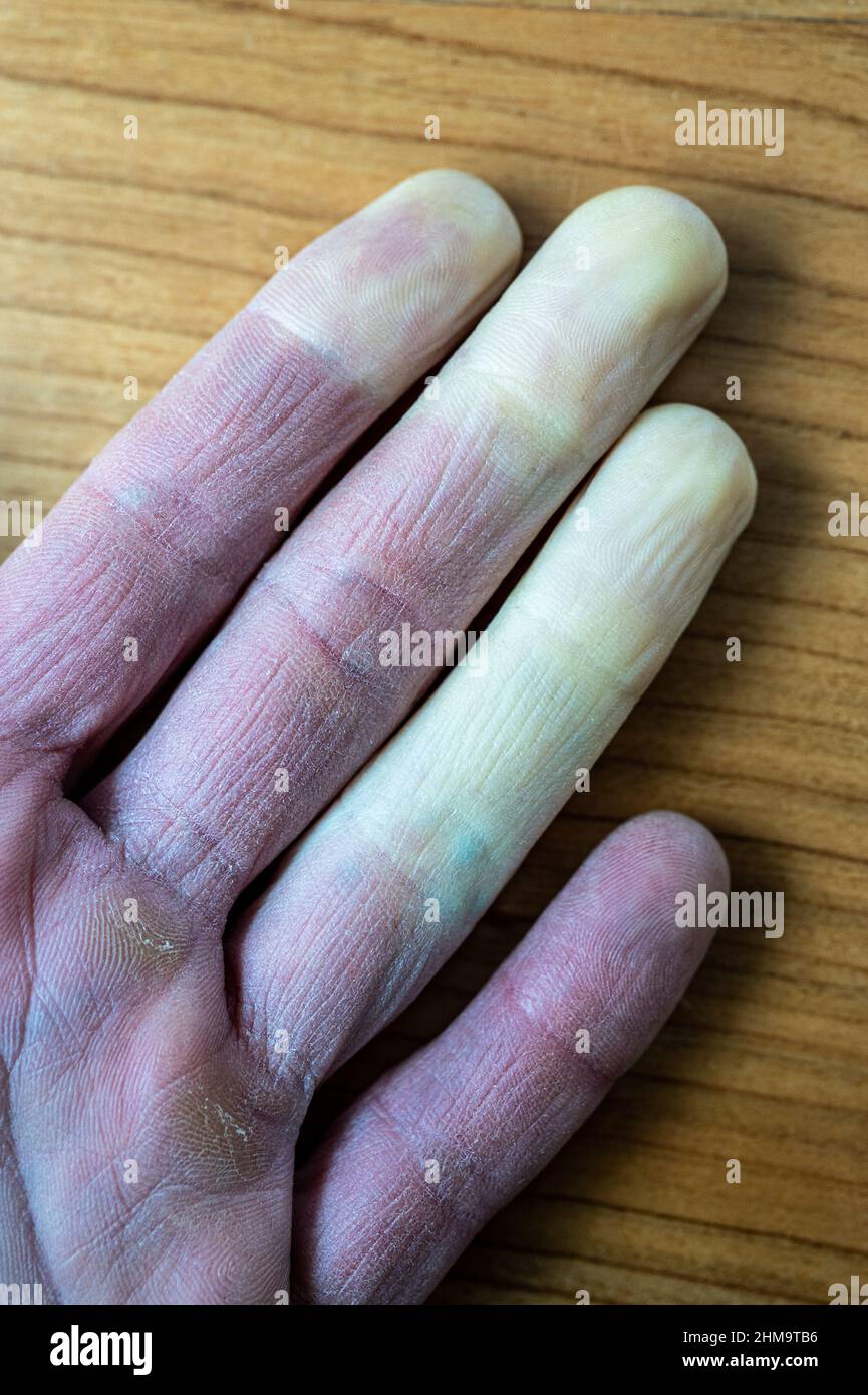 Eine erfrorene männliche Hand mit Raynaud-Syndrom, Raynaud-Phänomen oder Raynaud-Krankheit. Stockfoto