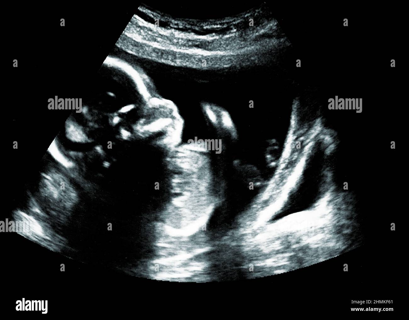 Ultraschall eines Babys im Mutterleib Stockfoto