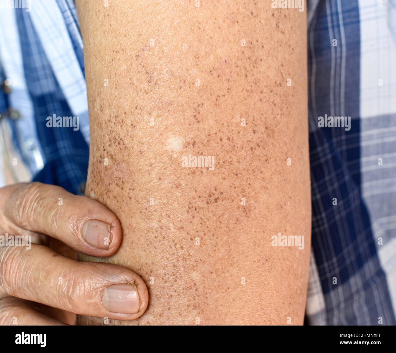 Altersflecken und weiße Flecken am Arm des älteren asiatischen Mannes. Altersflecken sind braune, graue oder schwarze Flecken und werden auch als Leberflecken, senile Linsen, Sonnenflecken bezeichnet Stockfoto