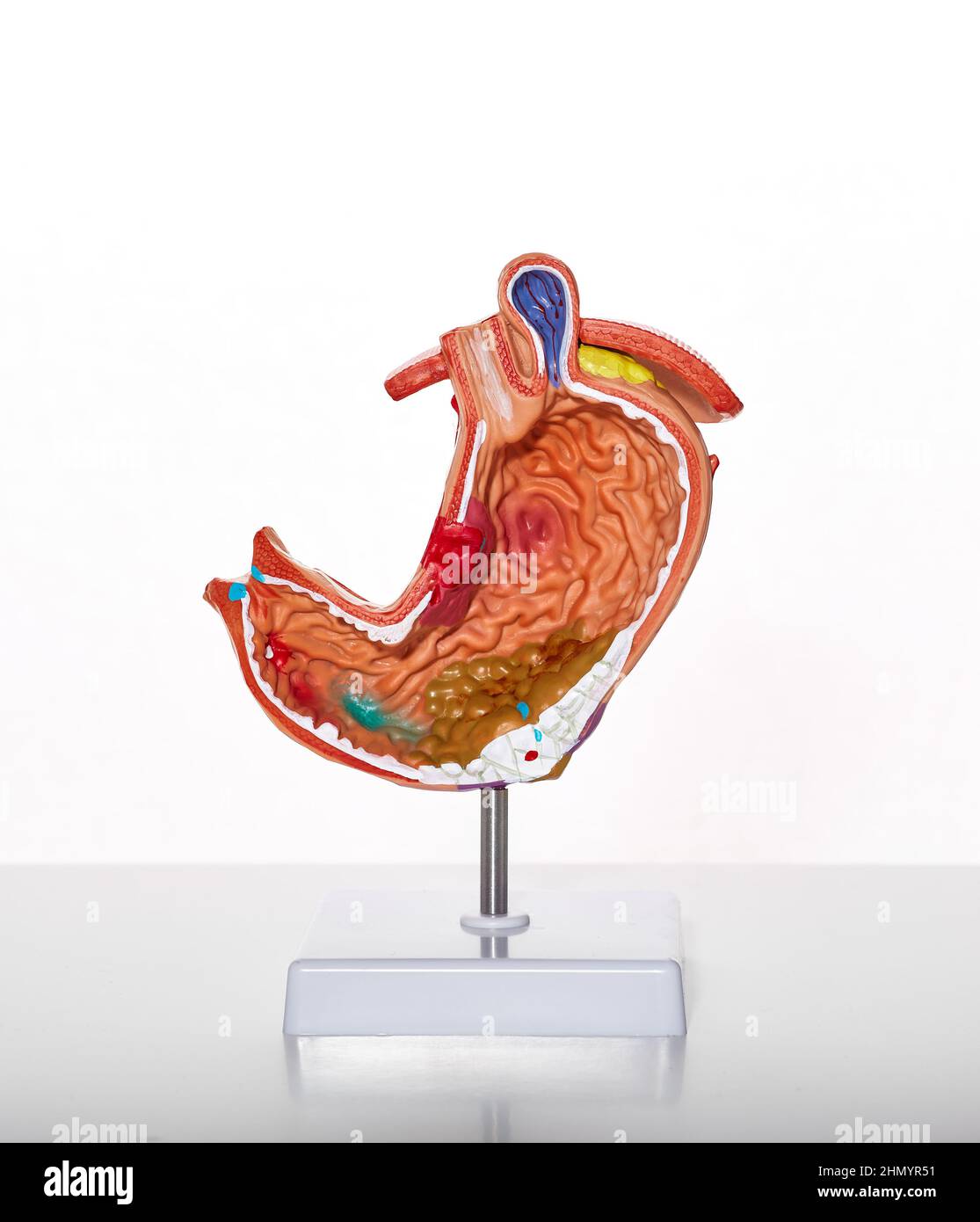 Visuelles anatomisches Modell des Magens mit Magenpathologien und Krankheiten, Geschwüren und Gastritis für die medizinische Ausbildung, Nahaufnahme Stockfoto