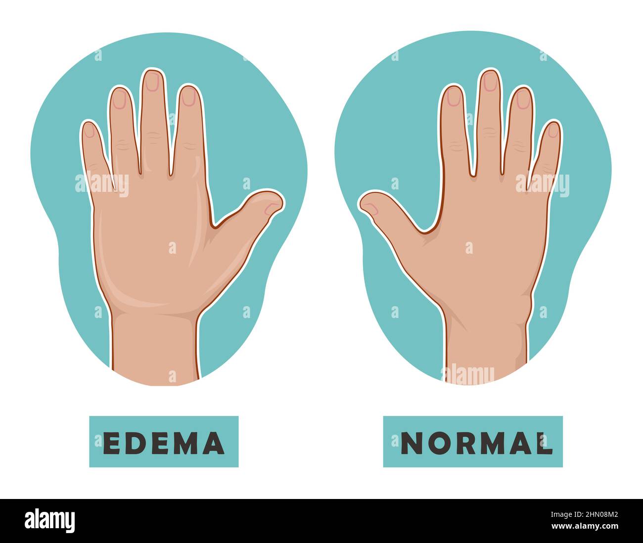 Geschwollene Hand und normale Hand. Ödem und Lymphodem ...