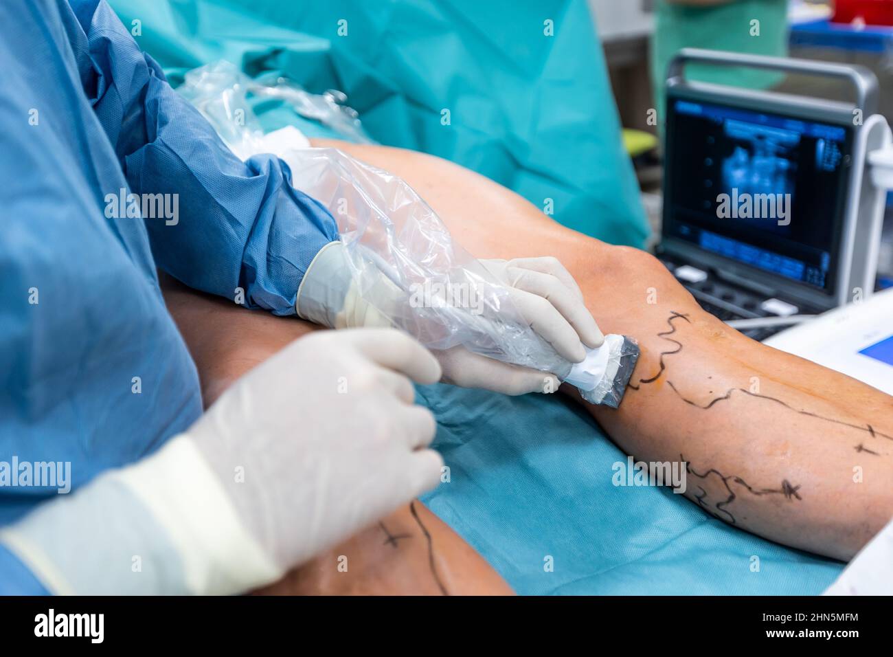 Verfahren der Krampfaderoperation im Krankenhaus, Operationssaal, Venenversiegelung, Konzept der venösen Gefäßchirurgie Stockfoto