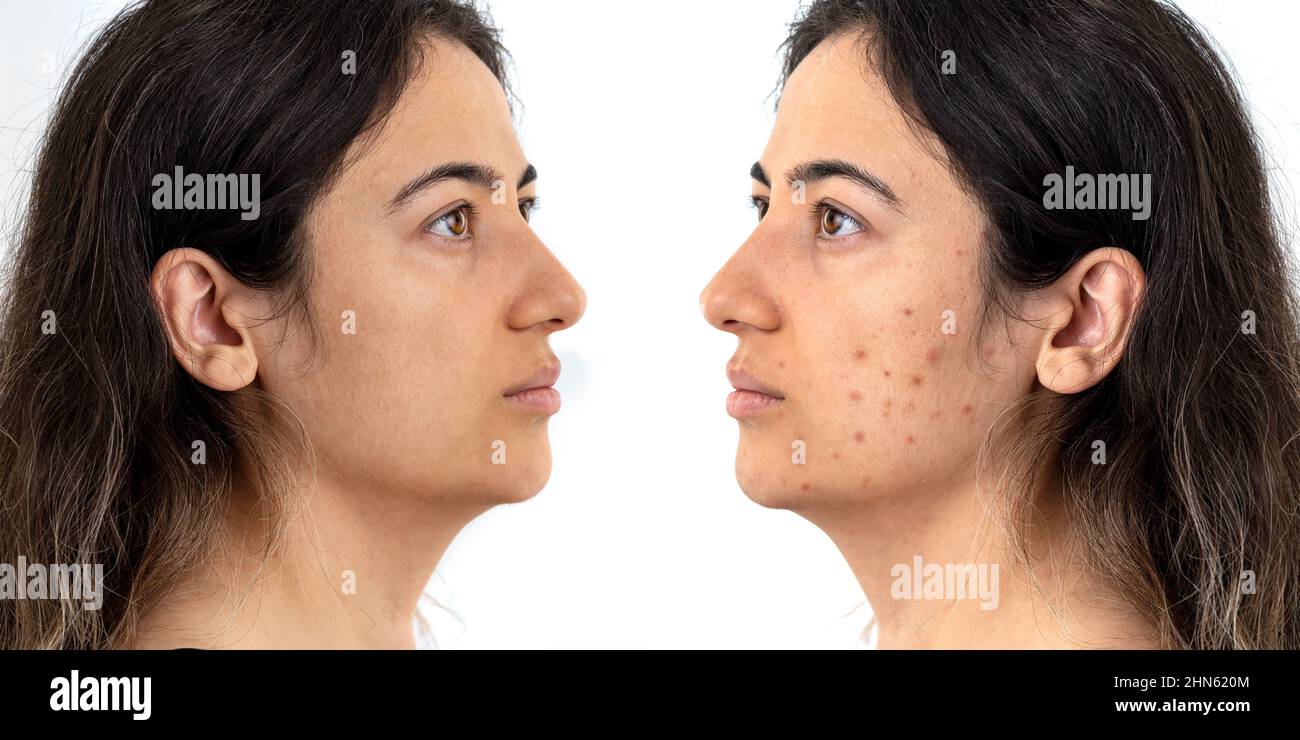 Vor nach dem Foto Foto von Frau mit übermäßigen amont von Pickel im Gesicht. Konzept der Schönheit und Hautpflege. Stockfoto