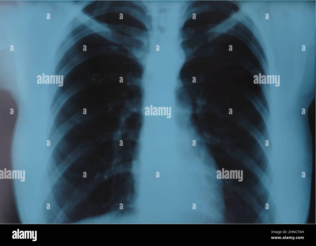 Ripp-MRT, Röntgenaufnahme der Brustwirbelsäule, Thorax-Röntgenuntersuchung, Fluorographiebild. Realistische Vektordarstellung Stock Vektor