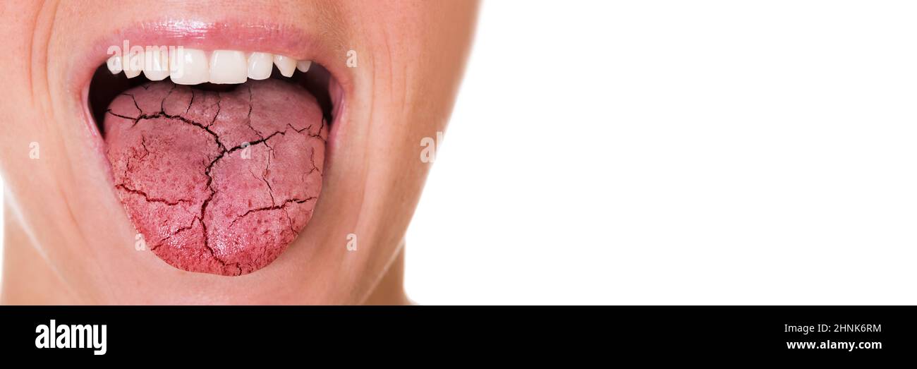Trockene Zunge Schmerzen Und Risse. Orale Candidiasis Stockfotografie