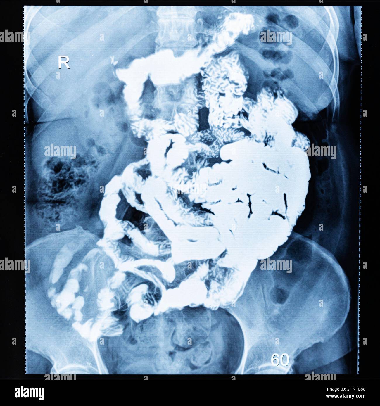 Bariumstudie mit Dünndarm nach 60 Minuten Stockfoto