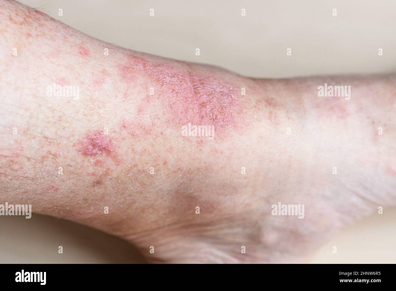 Probe der allergischen Kontaktdermatitis - Ekzem auf männlichem Schienengüterchen aus nächster Nähe Stockfoto