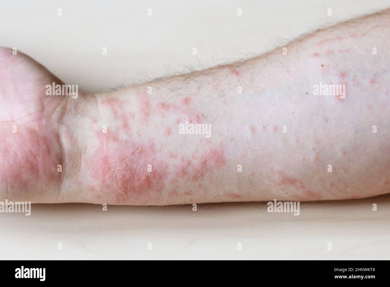 Probe der allergischen Kontaktdermatitis - juckender Ausschlag auf der Seite des Unterarms aus nächster Nähe Stockfoto