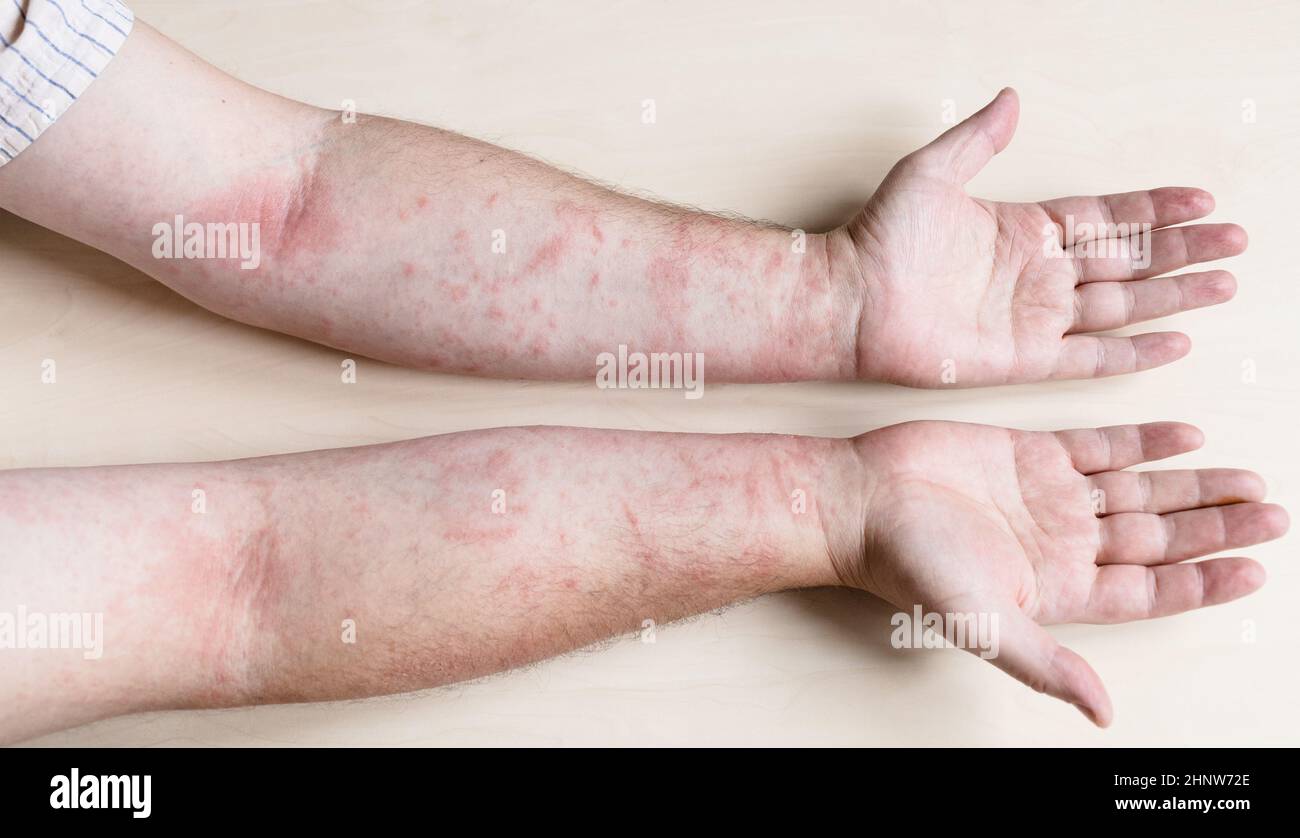 Probe der allergischen Kontaktdermatitis - männliche Arme durch Hauterkrankung infiziert Stockfoto