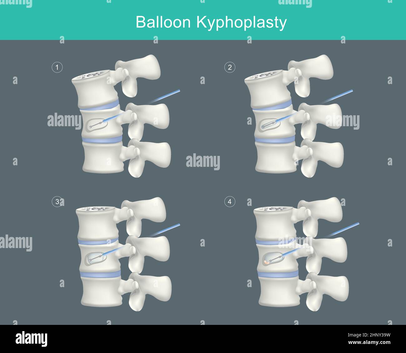 Ballon-Kyphoplastik. Medizinische Schritte zur Korrektur von Kompressionsfrakturen und Wiederherstellung der Körpergröße der Wirbelsäule. Abbildung. Stock Vektor