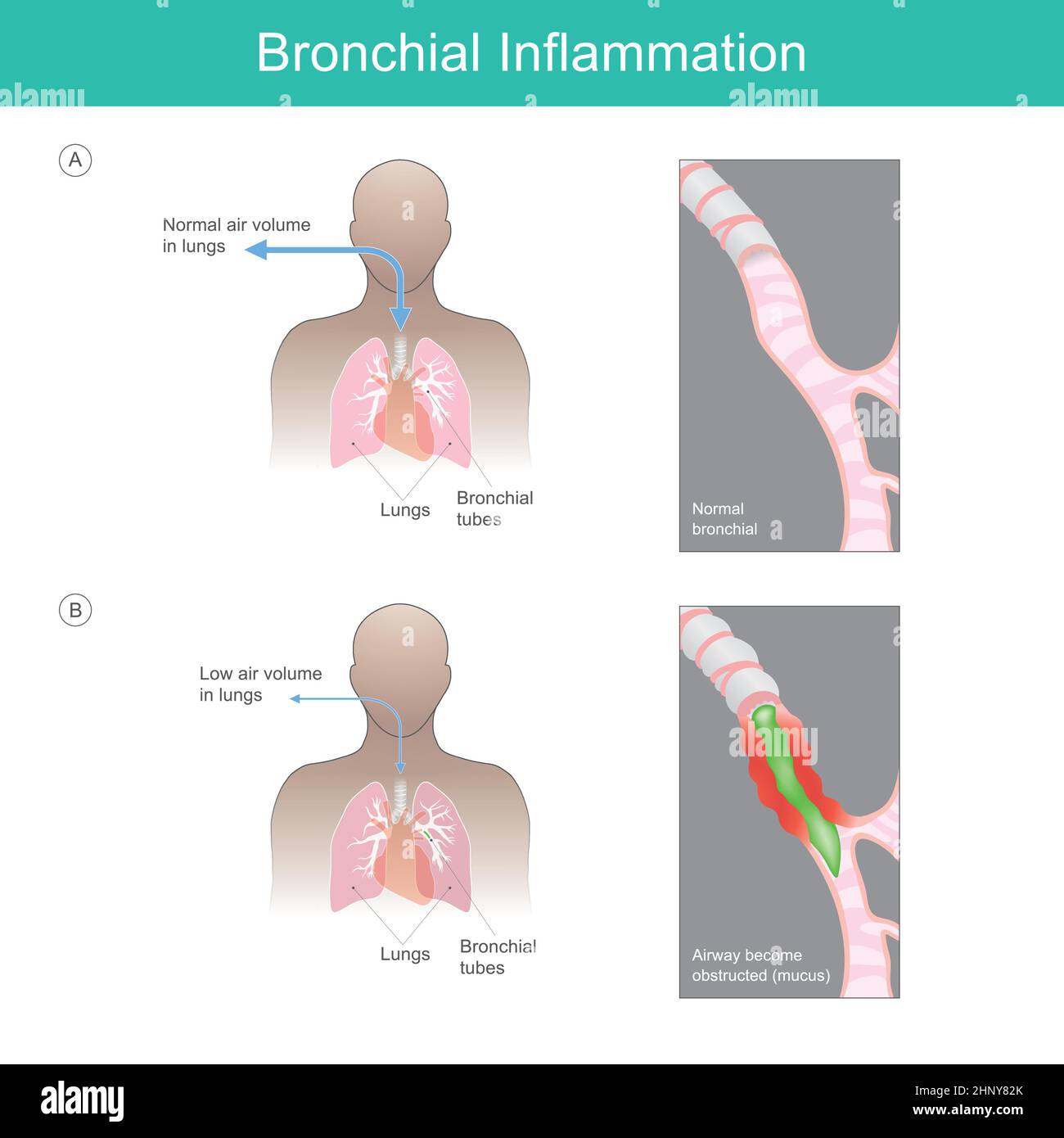 Bronchialentzündung. Illustration erklären Bronchialentzündung von einem Virus, Bakterien oder Reizpartikel lösen eine Entzündung aus und haben muc Stock Vektor