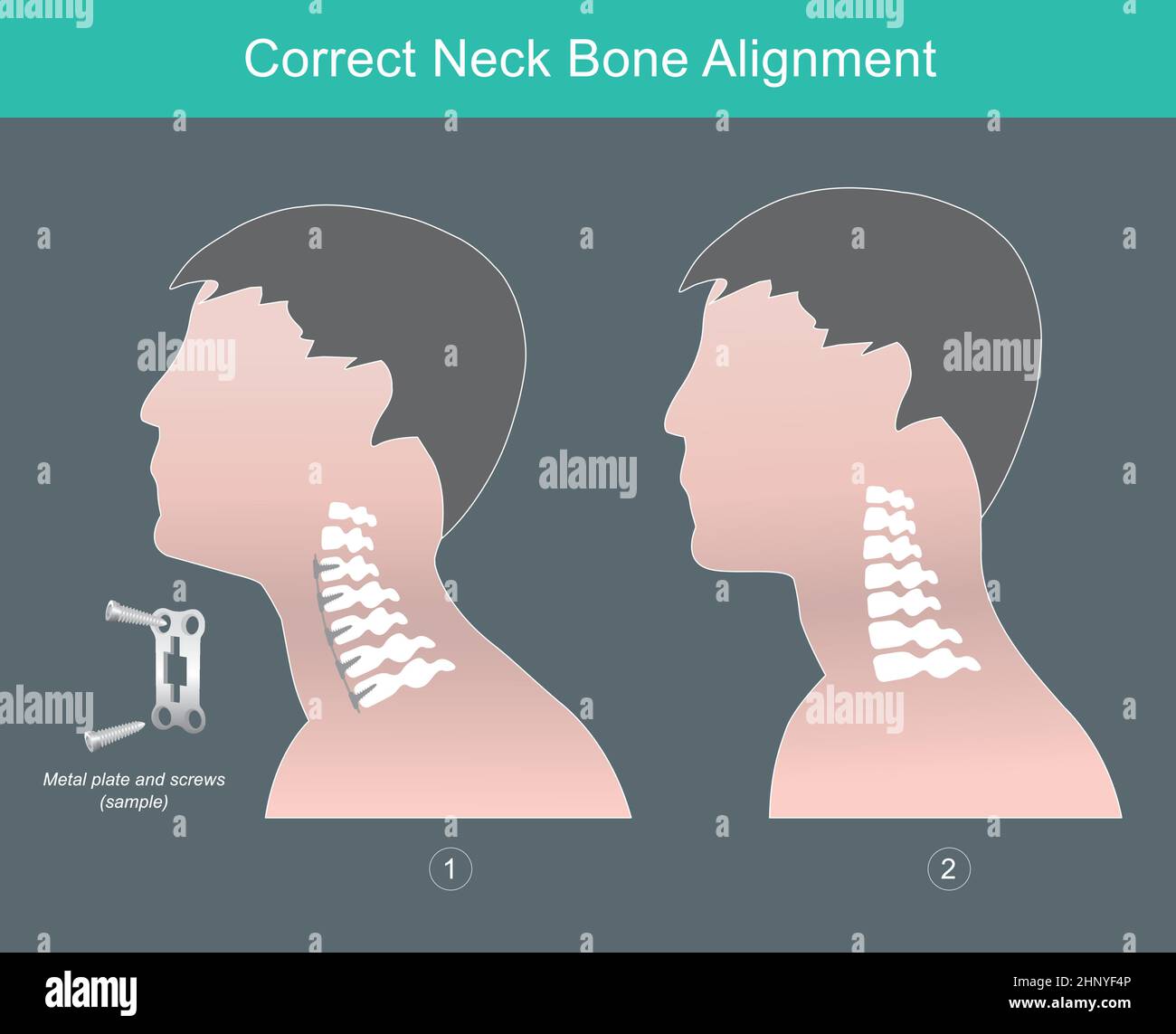 Korrekte Ausrichtung Der Halsknochen. Zeigt die korrekte Ausrichtung der Nackenknochen am menschlichen Seitenrand. Stock Vektor