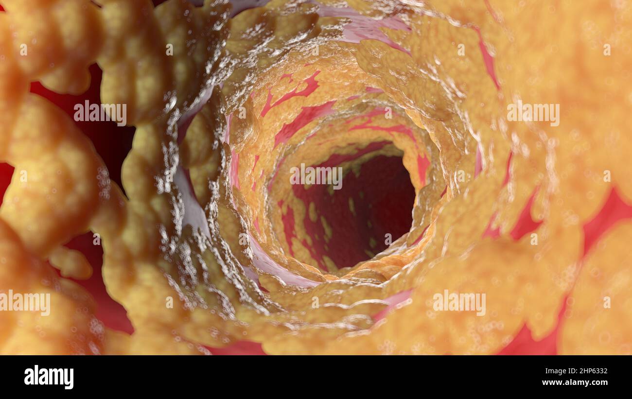 Fettsäuren menschlichen Arterie, Illustration Stockfotografie Alamy