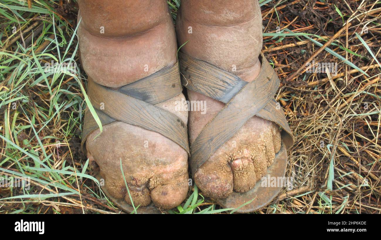 Podokoniose ist ein Lymphodem, das mit genetischer Anfälligkeit und barfuß-Exposition gegenüber Partikeln in vulkanischem Boden assoziiert ist. Es betrifft 1 von 20 Individuen in armen, endemischen Gebieten und ist eine vernachlässigte Tropenkrankheit. Um diesen Zustand zu vermeiden, werden Einzelpersonen ermutigt, Schuhe und Socken zu tragen und den Boden von ihren Füßen zu waschen, Praktiken, die nicht leicht zu erreichen sind und als Luxus unter den Armen gelten, wie der äthiopische Bauer, dessen Füße dargestellt sind. Ca. 10. März 2011 Stockfoto