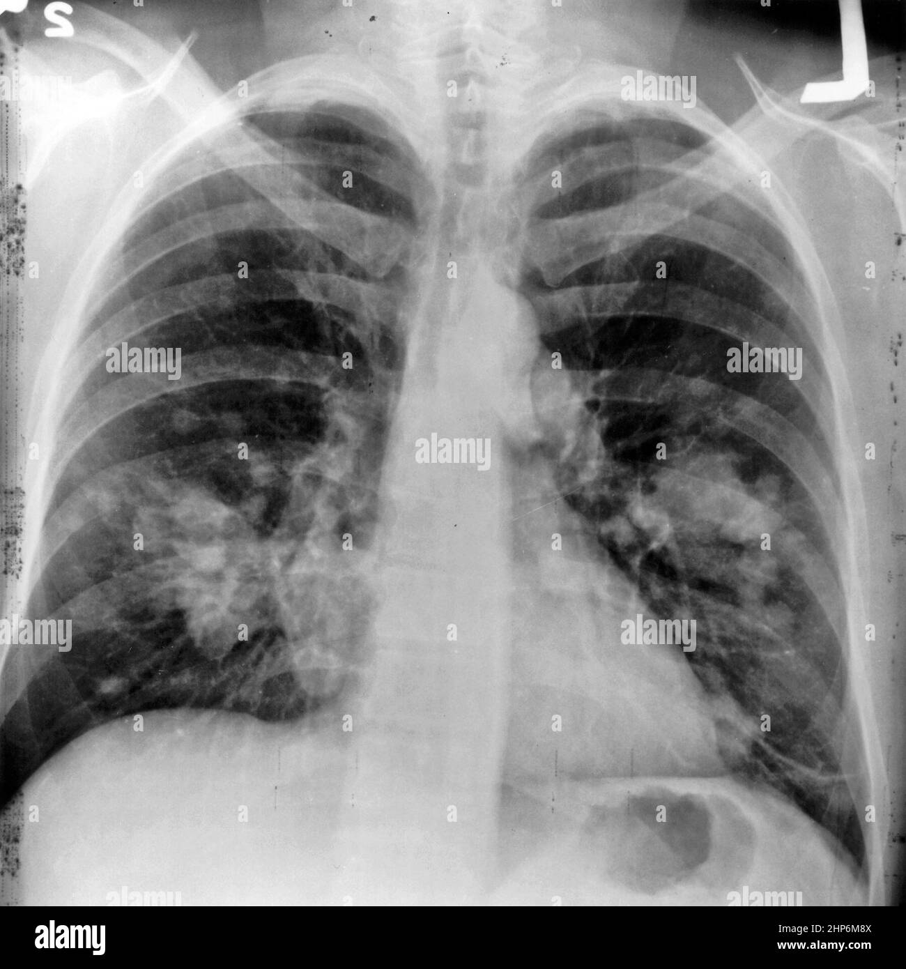 Ein Röntgenbild einer Brust. Beide Seiten der Lunge sind mit einem Wachstum auf der linken Seite der Lunge sichtbar, was möglicherweise Lungenkrebs sein könnte. 1998 Stockfoto