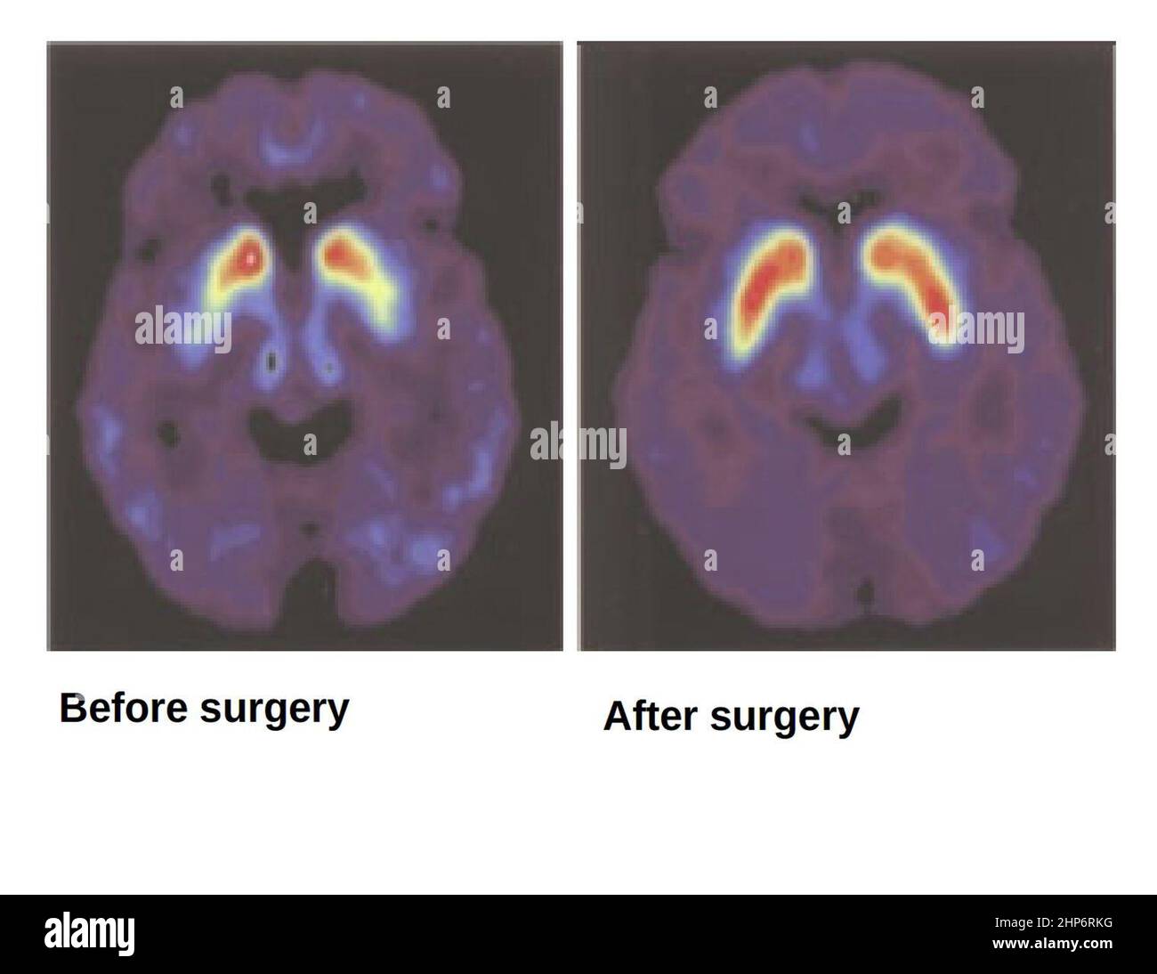 Positronen-Emissions-Tomograph eines Parkinson-Patienten vor und nach einer fetalen Gewebetransplantation. Das vor der Operation aufgenommene Bild (links) zeigt die Aufnahme einer radioaktiven Form von Dopamin (rot) nur im Zellkern des Kaudatums, was darauf hinweist, dass Dopamin-Neuronen degeneriert sind. Zwölf Monate nach der Operation zeigt ein Bild desselben Patienten (rechts) eine erhöhte Dopaminfunktion, insbesondere im Putam. Ca. 2004 Stockfoto