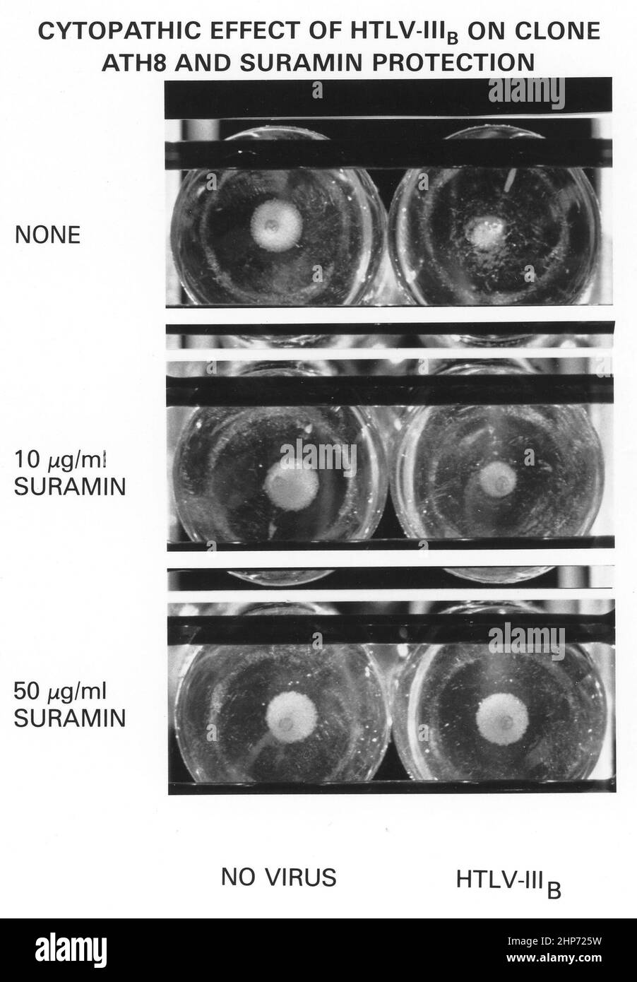 Die Fähigkeit des Medikaments Suramin, Helfer-T-Zellen (in Kultur) vor einer HIV-I-Infektion (HTLV-III) zu schützen b). Auf der linken Seite jedes Paares befinden sich nicht infizierte Helfer-T-Zellen. In der oberen Reihe rechts sind die vom HIV-I abgetöteten T-Zellen, die mittleren T-Zellen teilweise mit Suramin geschützt und die unteren T-Zellen vollständig durch Suramin gegen die HIV-I-Infektion geschützt. Beachten Sie, dass die T-Zellen, wenn sie durch Suramin geschützt sind, nicht zerstört werden. November 1985 Stockfoto