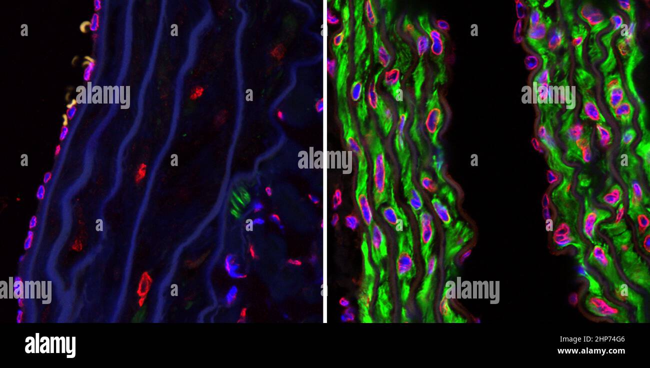 Konfokale Mikroskopieaufnahmen der absteigenden Aortas von zwei 15 Monate alten Progeria-Mäusen, eines unbehandelt (linkes Bild) und das andere mit dem Farnsyltransferase-Inhibitor Tipifarnib (rechtes Bild) behandelt. Die Mikrofotos zeigen die Prävention des vaskulären Verlustes der glatten Muskelzellen, der bis zu diesem Alter sonst grassiert. Die Färbung erfolgte mit Alpha-Actin (grün), Laminen A/C (rot) und DAPI (blau). (Originalvergrößerung, x 40) ca. 2009 Stockfoto
