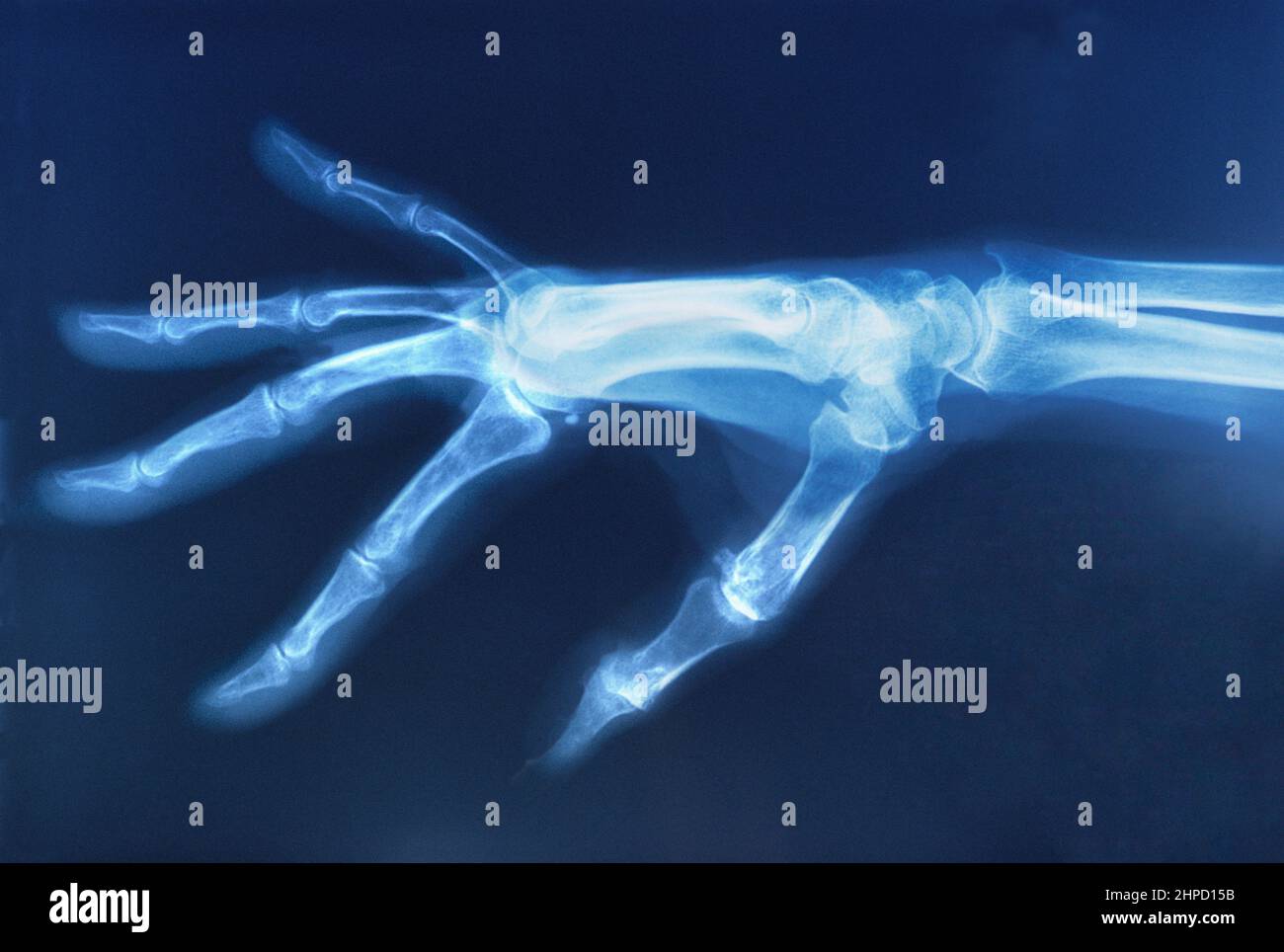 Hand-Röntgenaufnahme eines Erwachsenen. Orthopädische Diagnostika. Körperteil für Erwachsene. Radiologie Stockfoto
