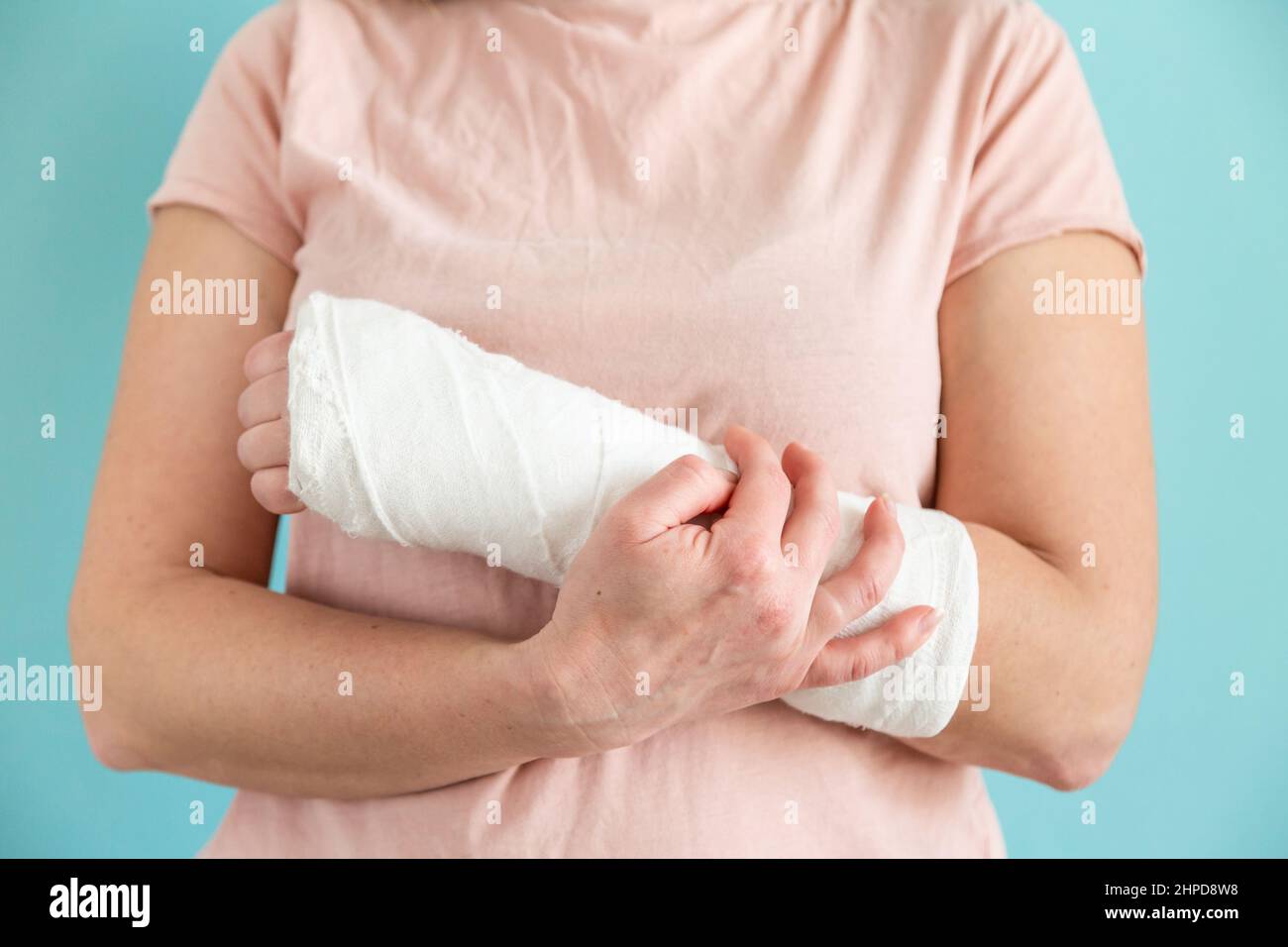Frau mit gebrochenem Arm. Hand in einen Gipsverband. Gipsmedizin Stockfoto