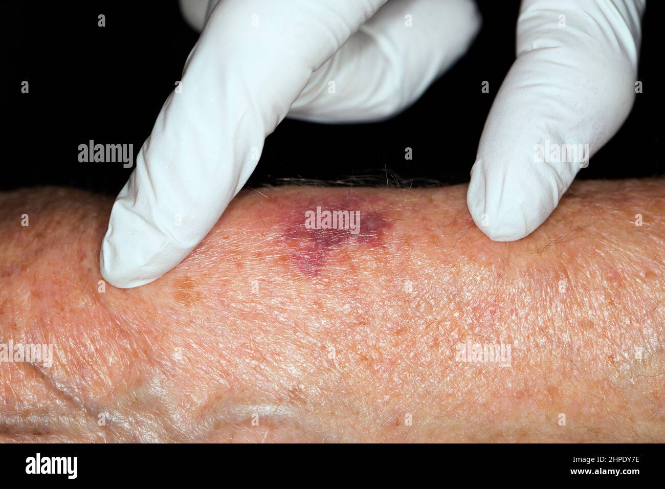 Senile purpura Fotos und Bildmaterial in hoher Auflösung Alamy