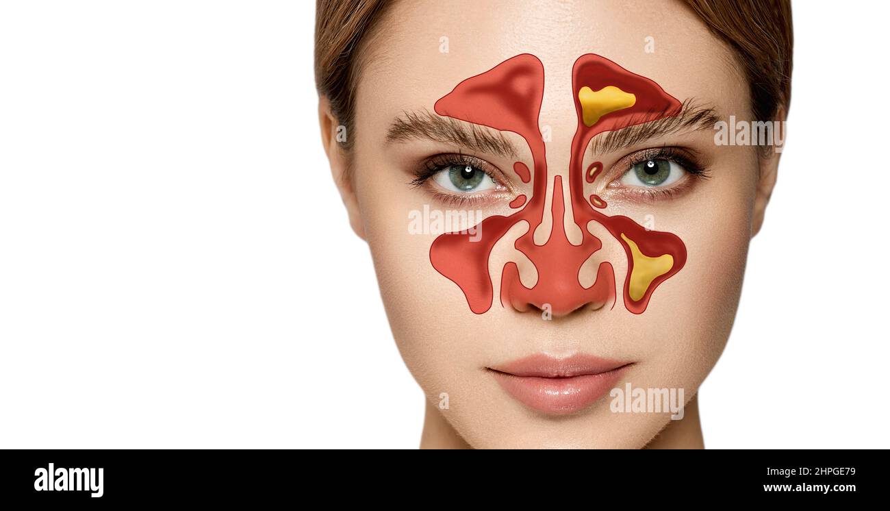 Sinusitis, Frontitis. Weibliches Gesicht mit Entzündung der Schleimhaut der Nasennebenhöhlen und der Stirnhöhlen Stockfoto