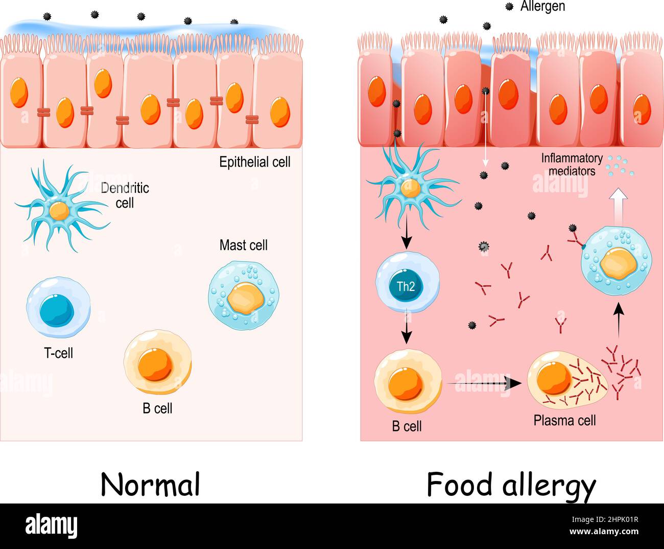 Lebensmittelallergie ist eine abnorme Immunantwort auf Lebensmittel. Zelle des normalen Epithels und Nahrungsmittelallergie. Entwicklung einer allergischen Reaktion von Allergenen Stock Vektor