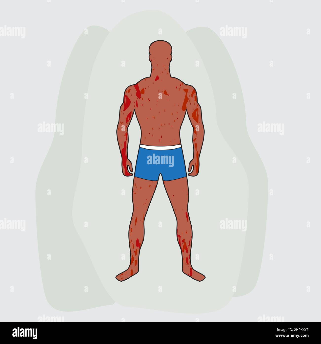 Gebräunter schlanker Mann in blauen Badehosen. Männliche Figur in vollem Wachstum. Roter Hautausschlag und Flecken bedecken den ganzen Körper. Dermatologische Krankheitszeichen und Symptome Stock Vektor