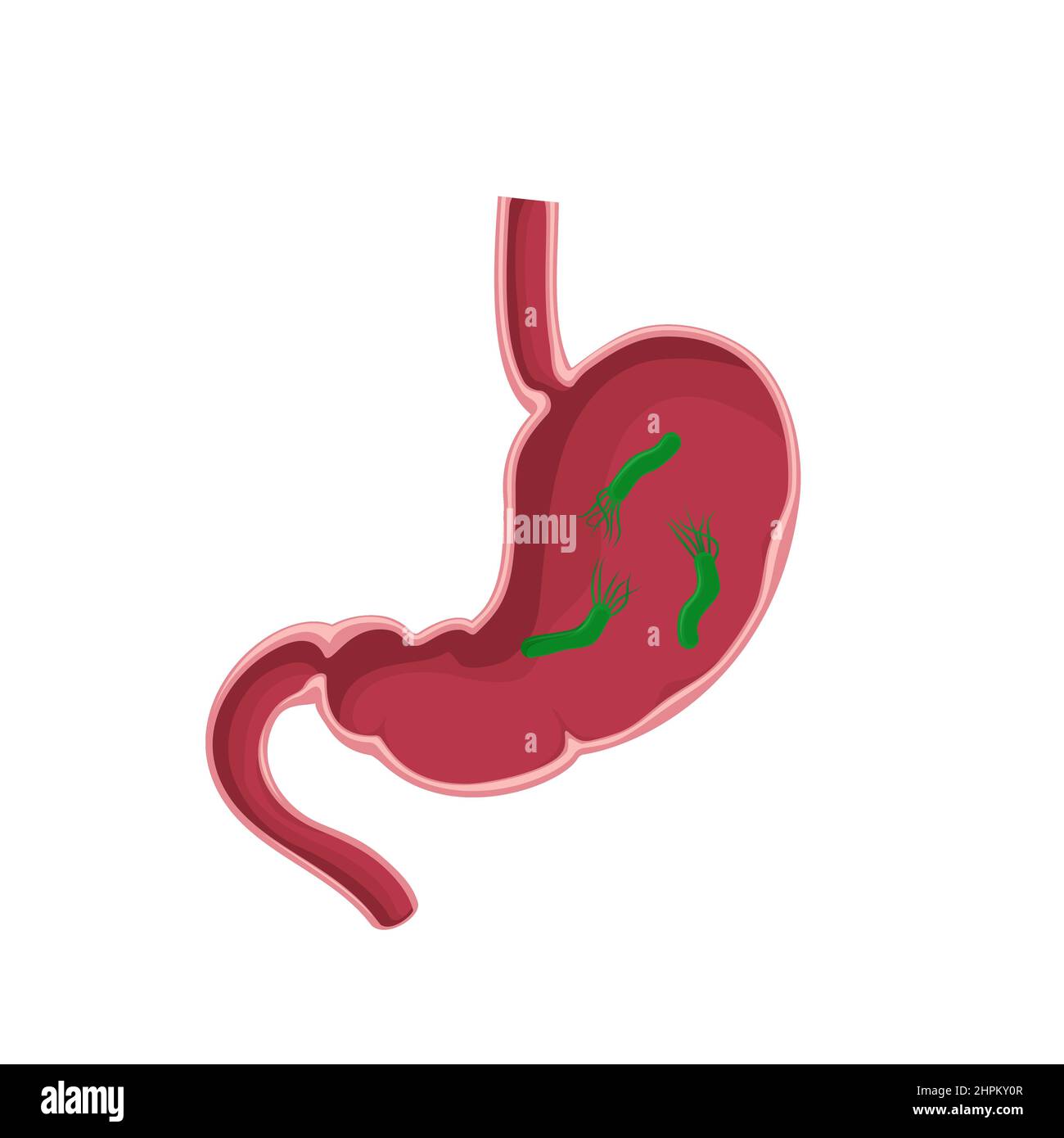Helicobacter Pilori, mit dem menschlichen Magen infiziert. Medizinisches Konzept. Abbildung der Magenerkrankung auf weißem Hintergrund. Stock Vektor