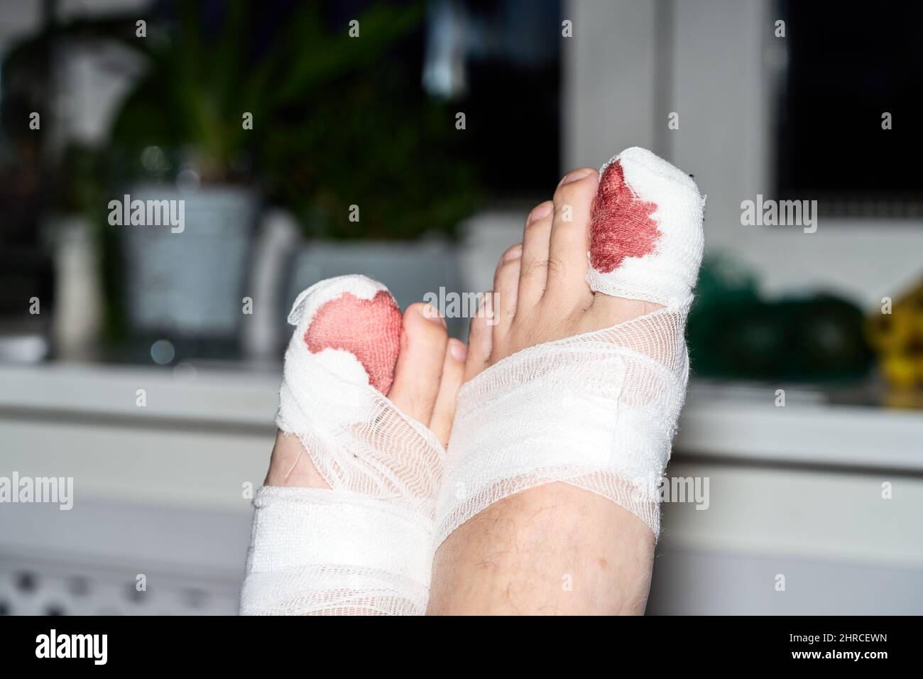 Die Beine eines Mannes mit blutbandagierten großen Zehen. Fenster im Hintergrund Stockfoto