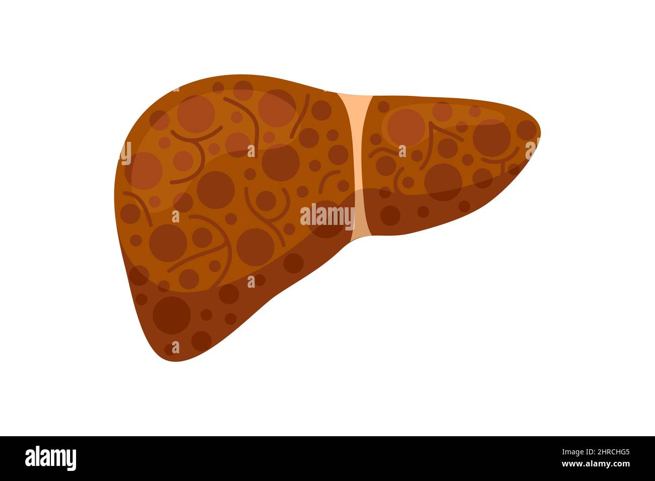 Kranke, ungesunde Leber mit Gelbsucht oder Hepatitis. Konzept zur Zerstörung von Organen der menschlichen exokrinen Drüse. Vektor fettige hepatische eps isolierte Illustration Stock Vektor