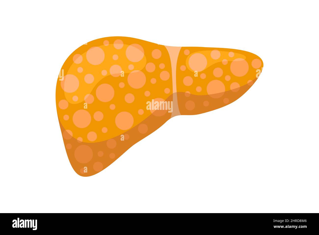 Kranke, ungesunde Leber mit Gelbsucht oder Hepatitis. Konzept zur Zerstörung von Organen der menschlichen exokrinen Drüse. Vektor hepatische eps Illustration Stock Vektor