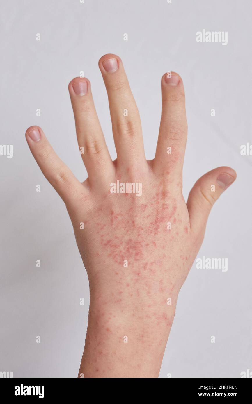 Allergische Reaktionen auf die Haut des Patienten Hände. Krank allergischer Hautausschlag Dermatitis Ekzem Stockfoto