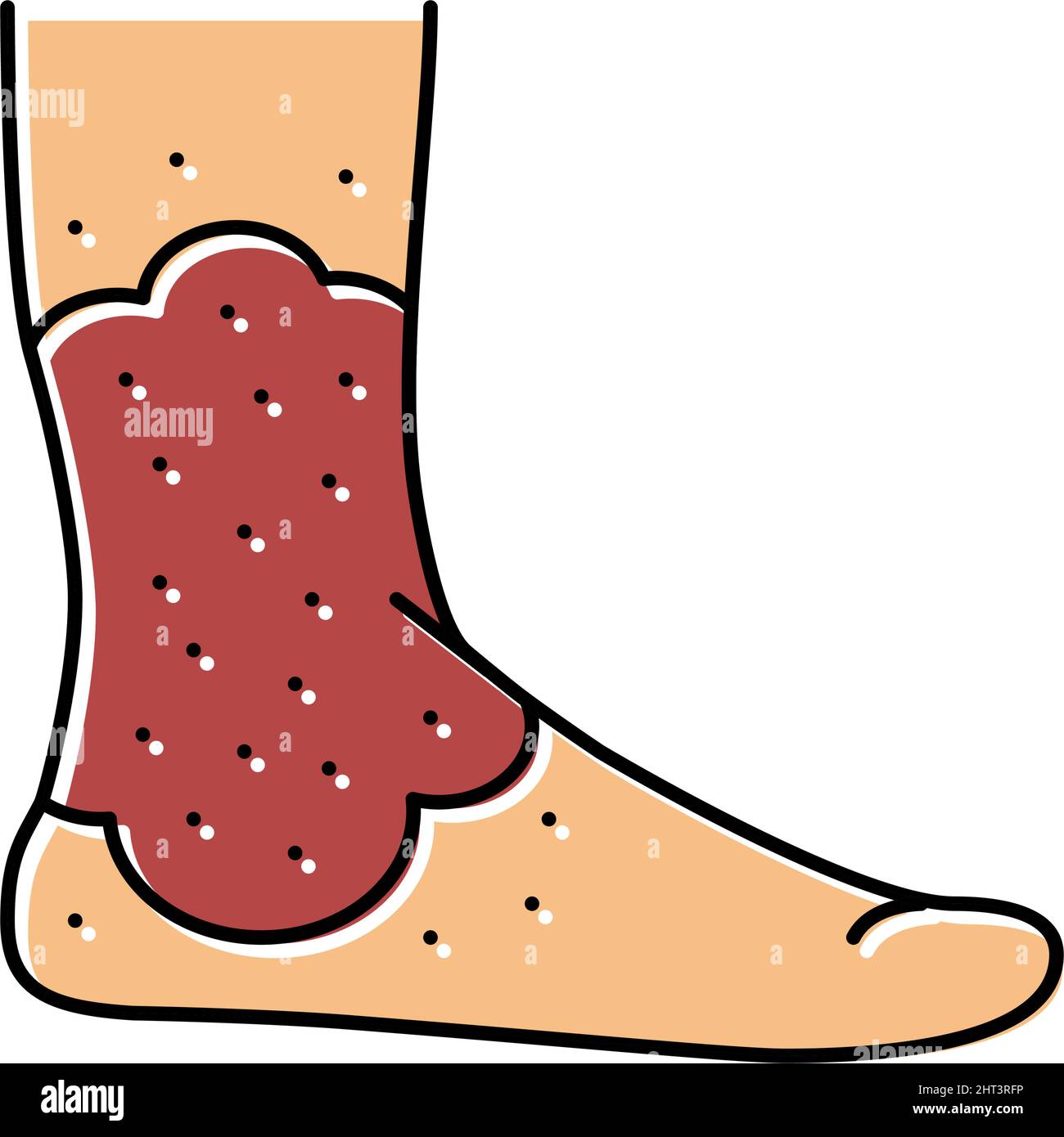 Darstellung des Symbols für die Farbe der Stasis-Dermatitis Stock Vektor