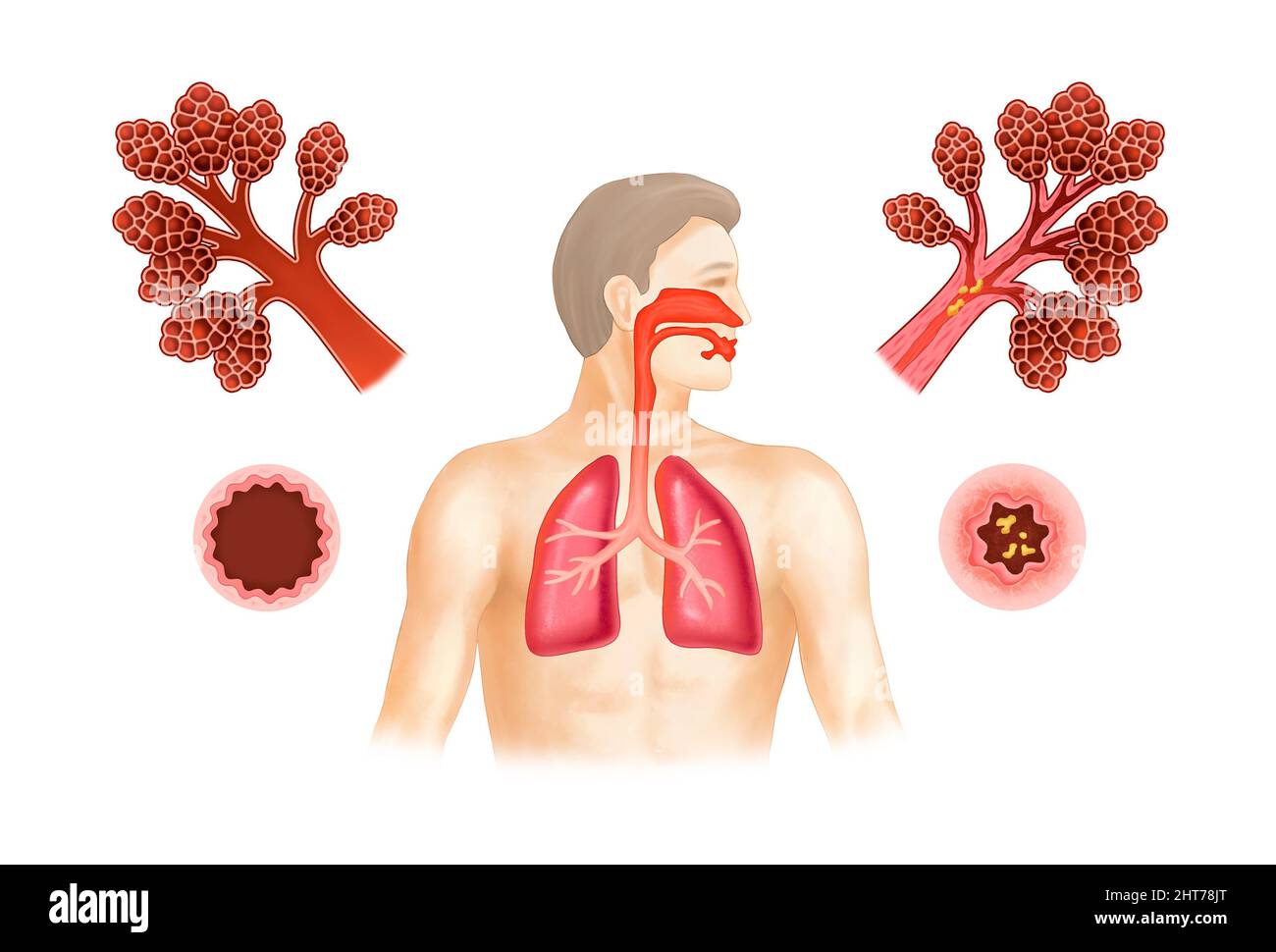 Eine realistische Darstellung von Asthma und menschlicher Anatomie Stockfoto