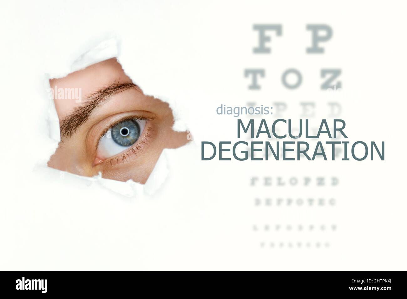 Makuladegeneration-Krankheit-Poster mit Augentestdiagramm und blauem Auge.isoliert auf Weiß Stockfoto