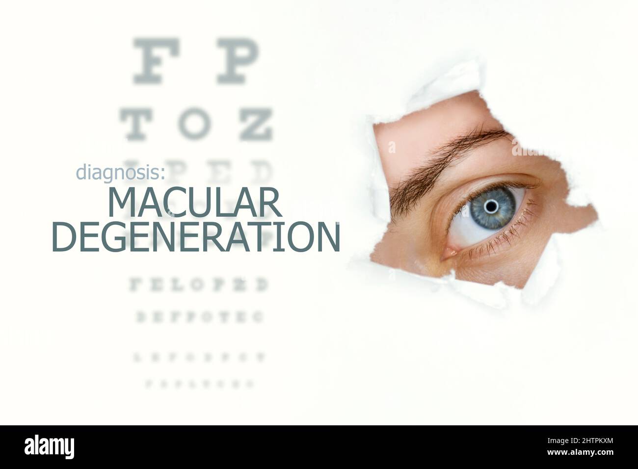 Makuladegeneration-Krankheit-Poster mit Augentestdiagramm und blauem Auge.isoliert auf Weiß Stockfoto