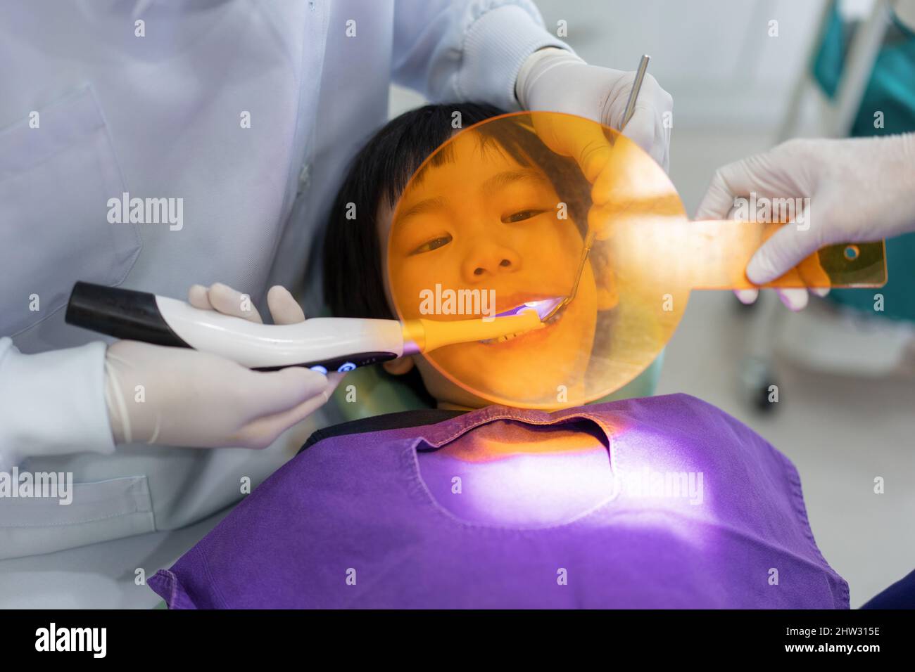 Hand of Doctor Zahnarzt arbeitet an den Zähnen der asiatischen kleinen Kind 6 Jahre alten Patienten in der Zahnklinik, Dental-Füllung, Zahnarzt mit ultraviolettem Seufzer Stockfoto