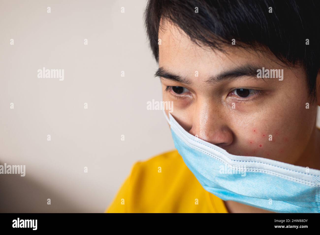 Akne im Gesicht. Es ist eine allergische Reaktion von Hitze und
