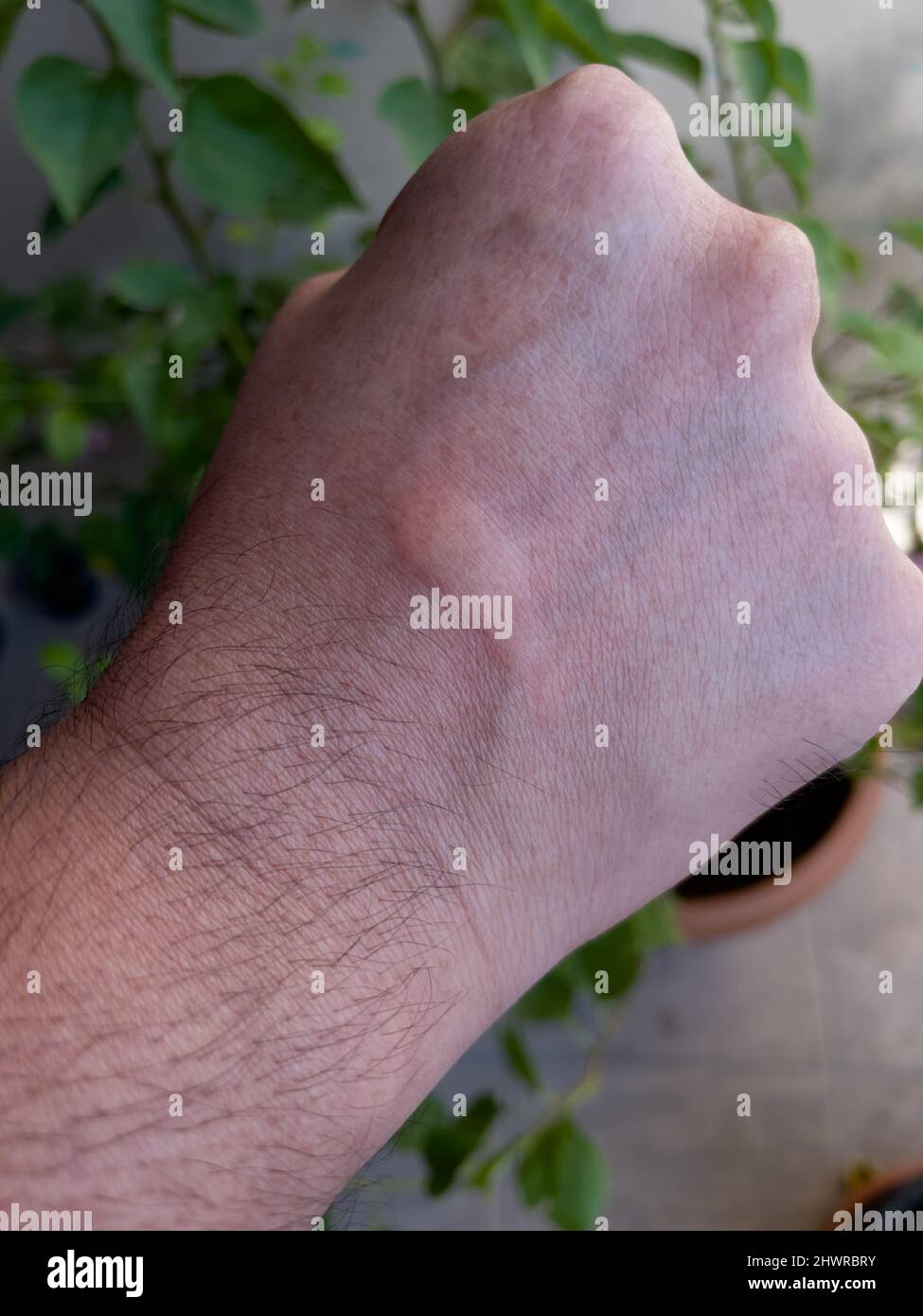 Nahaufnahme der Schwellung auf dem Handrücken, die durch Insekt- oder Insektenstich im Garten verursacht wird. Stockfoto