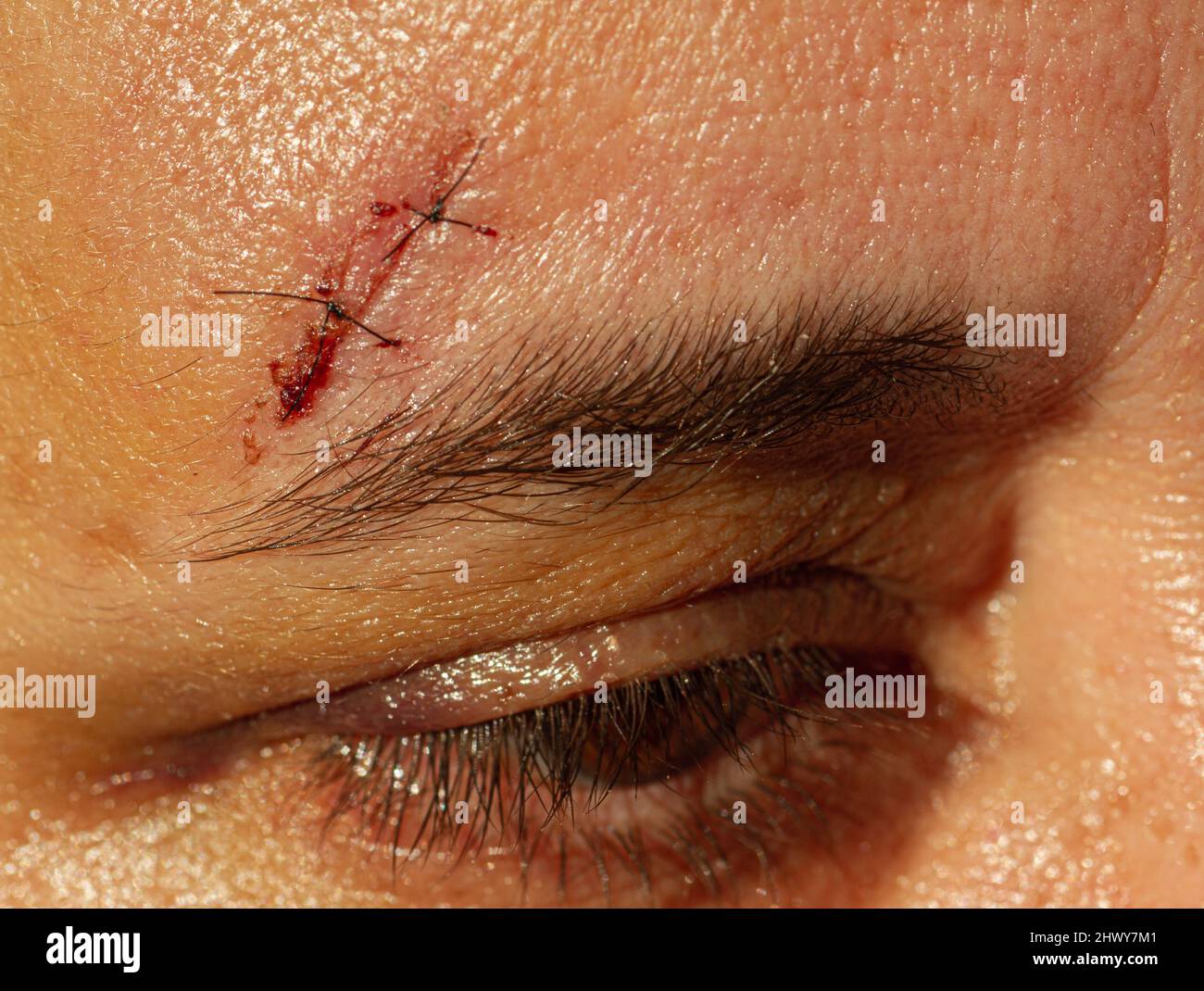 Weiße Frau mittleren Alters mit Stichen über ihrem Auge aufgrund eines Sturzes. Stockfoto