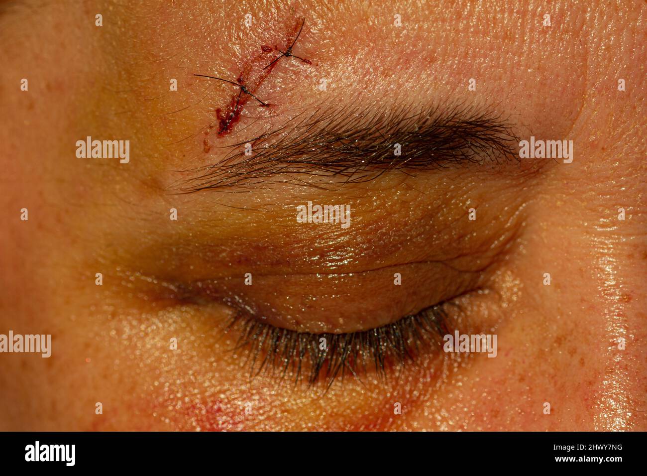 Weiße Frau mittleren Alters mit Stichen über ihrem Auge aufgrund eines Sturzes. Stockfoto