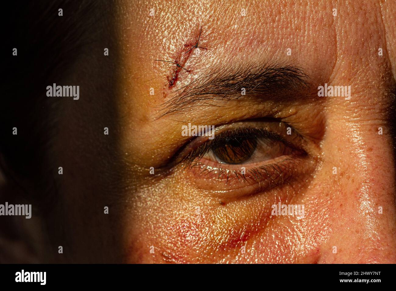 Weiße Frau mittleren Alters mit Stichen über ihrem Auge aufgrund eines Sturzes. Stockfoto
