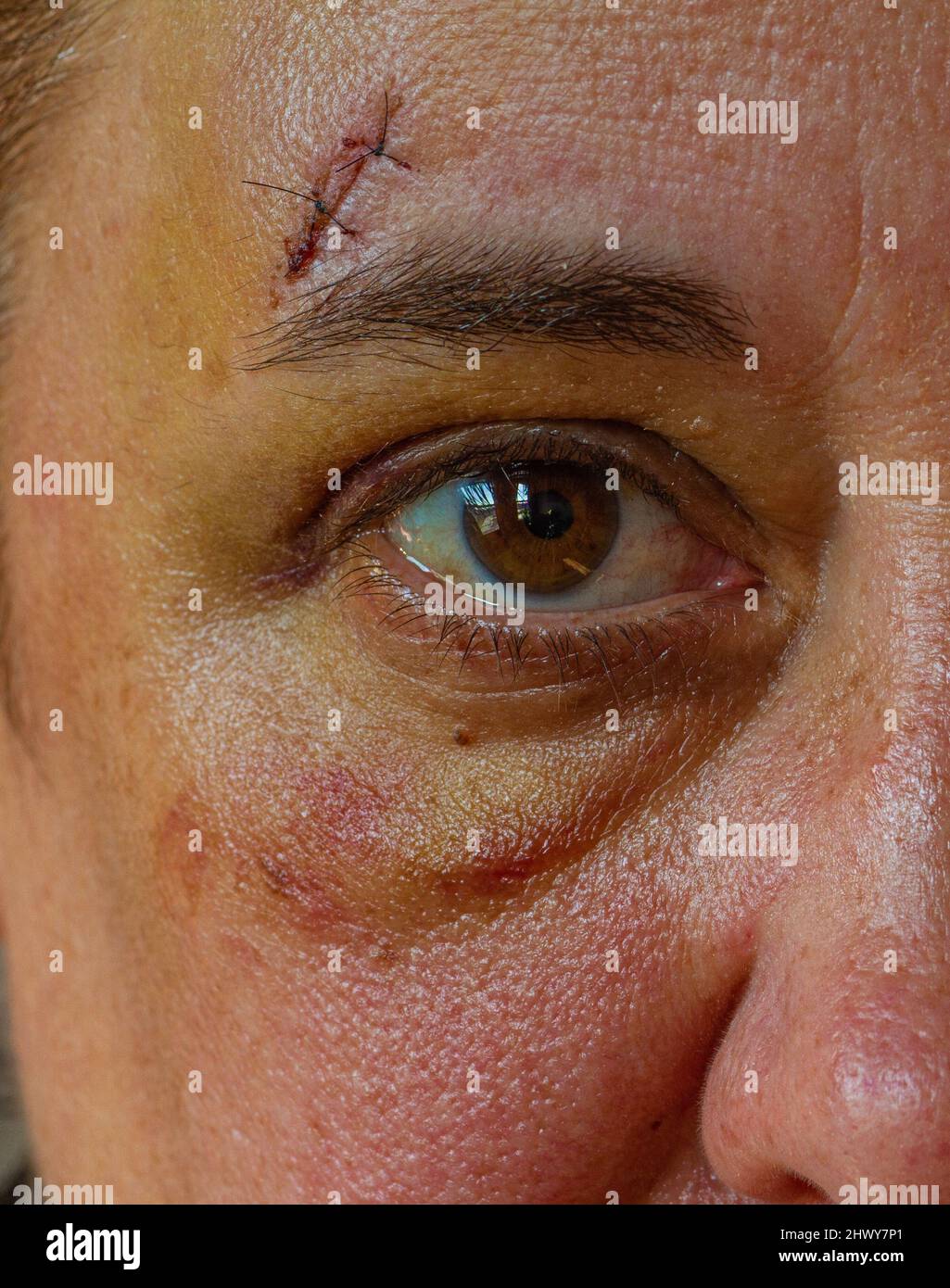 Weiße Frau mittleren Alters mit Stichen über ihrem Auge aufgrund eines Sturzes. Stockfoto