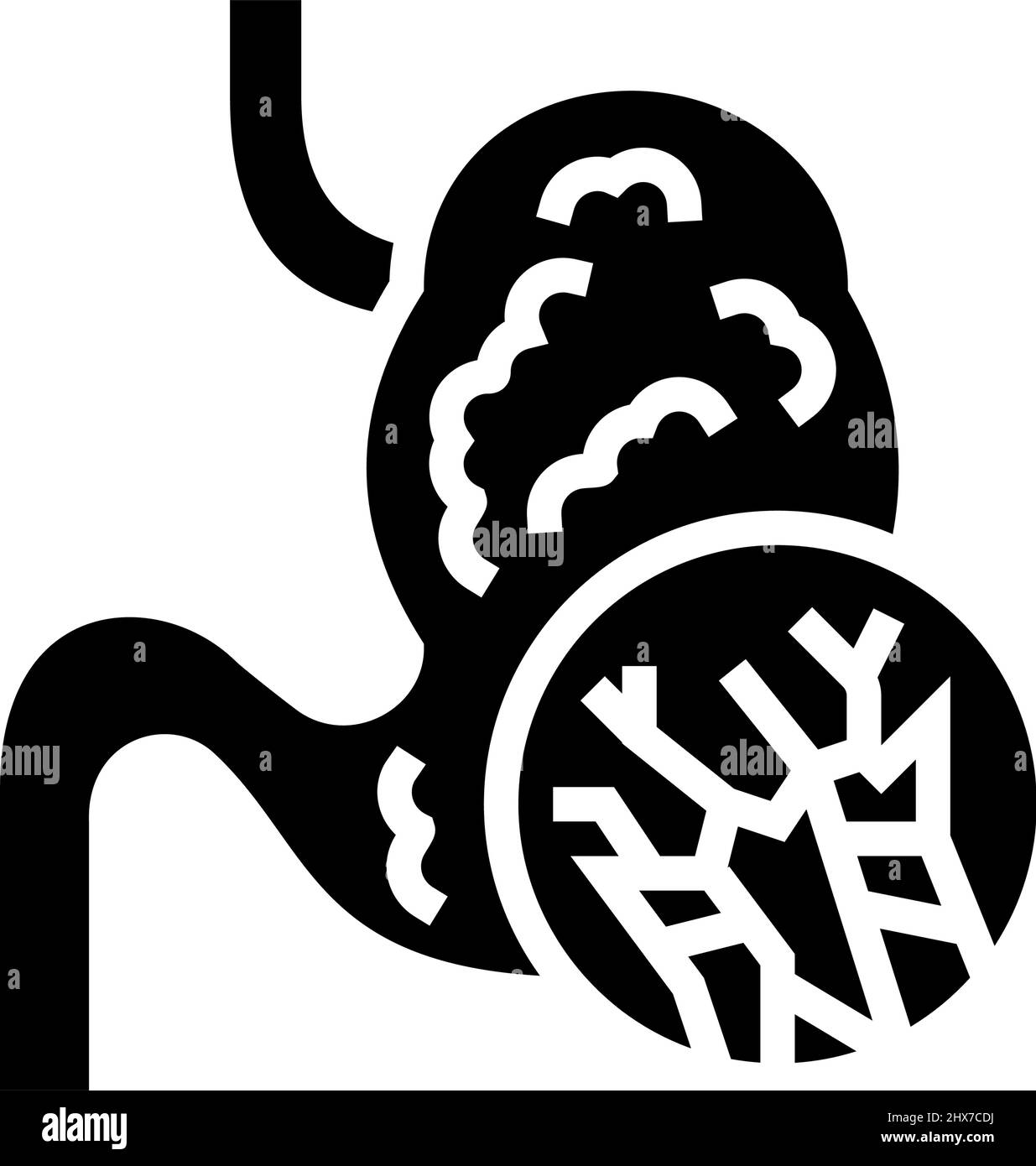 Abdominale Schwellung Mesotheliom Glyphe Symbol Vektor Illustration Stock Vektor