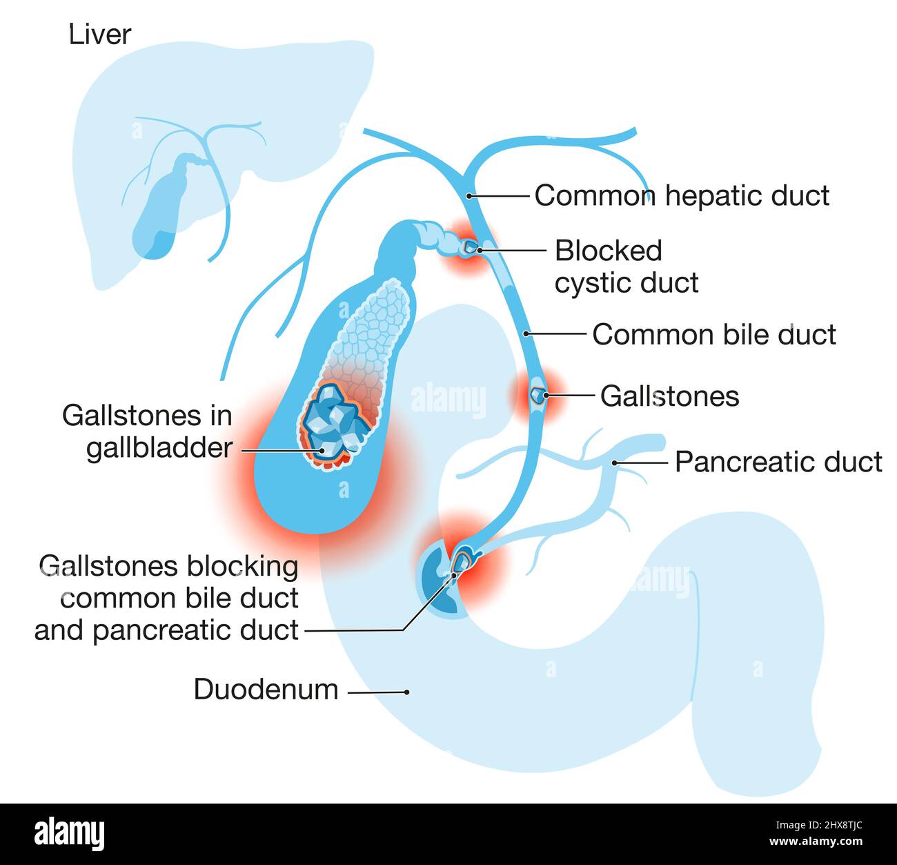 Gallensteinkrankheit. Gallensteine blockieren den Gallengang und den Pankreasgang. Beschriftete Abbildung Stockfoto